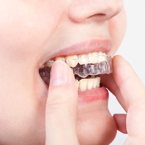 マウスピース型矯正装置